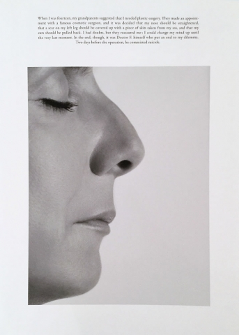 Sophie Calle, Le nez / The plastic surgery, Print 20 x 27 1/2 inches